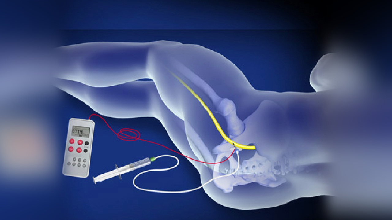 Medical illustration of nerve stimulation procedure.